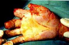 Amputierte Finger durch geschrumpften Handschuh